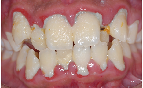 Gum Treatment at Neua Dental